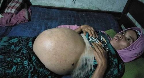 Ummi Janita Butuh Uluran Tangan Para Donatur