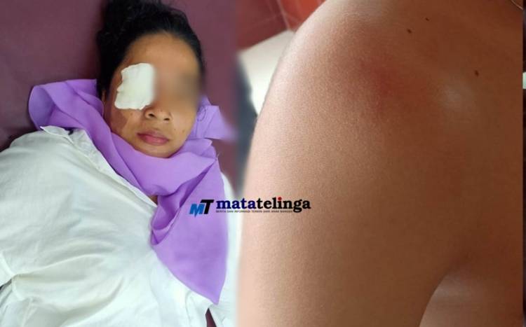 Pelaku Kabur Usai Siram Air Keras ketubuh Korban