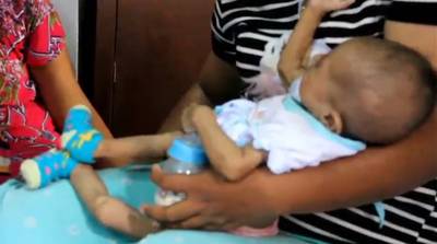 Sisihkan Rejeki.  Bayi Lahir  Tanpa Anus dan Mengalami Pembengkakan Jantung Butuh Bantuan