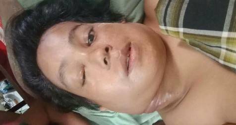 Menderita Tumor Ganas Di Leher, Nurhazimah Warga Tanjung Leudong - Labuhanbatu Utara Butuh Bantuan