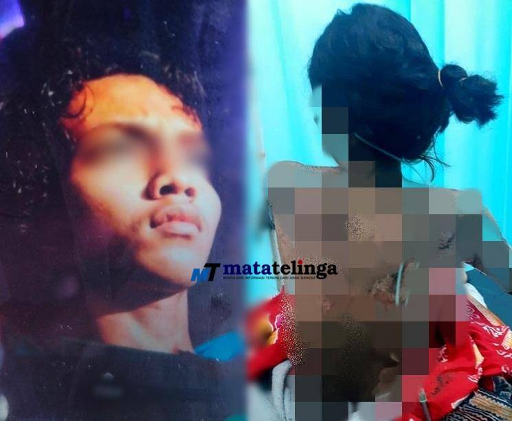 Tersulut Emosi GFS Tega Siram Bensin Dan Bakar Kakak Kandung