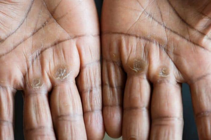 Tangan Kamu Sering kapalan, Yuk Lakukan Tips Berikut Untuk Mengilanginya