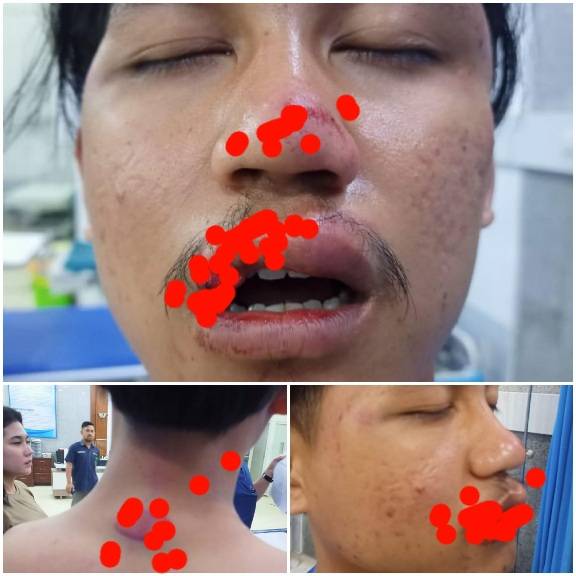 Pulang Antar Pacar, Babak-belur Dipukuli 10 Begal di Belawan