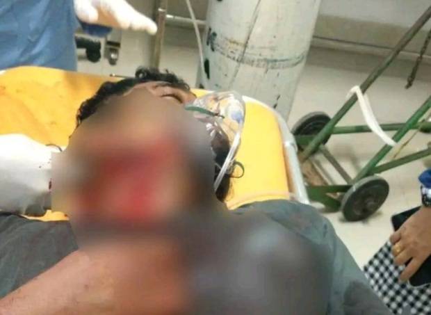 Sedang Tidur Pulas diatas Medan, Pipi Kanan di Sayat