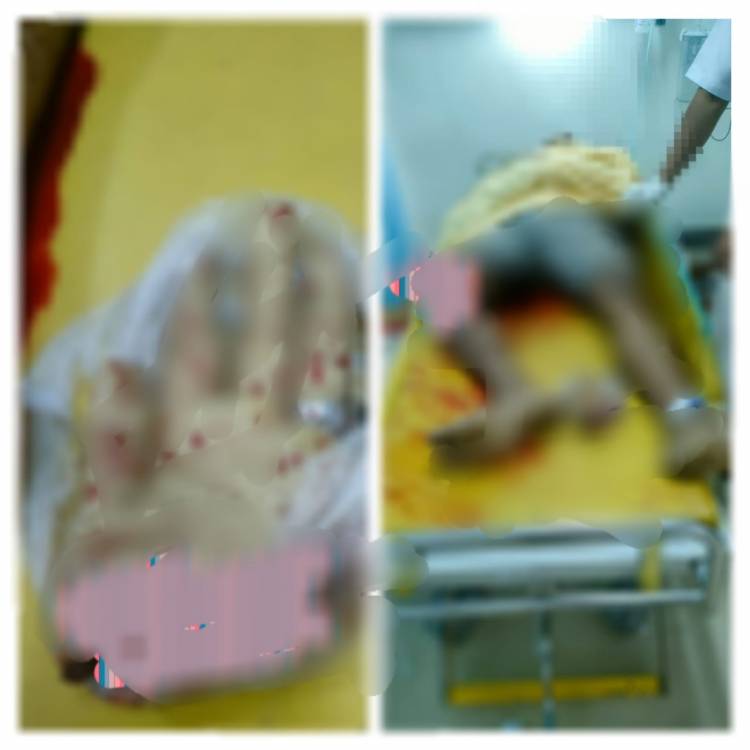 Disenyalir Kerap Meminta  Uang, Tangan Fahruzi Putus Dibacok