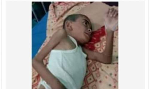 Rizky Hidayat Bocah 7 Tahun, Penderita Stunting Dan Jantung Bocor Mengidap Penyakit Aneh Sejak Lahir