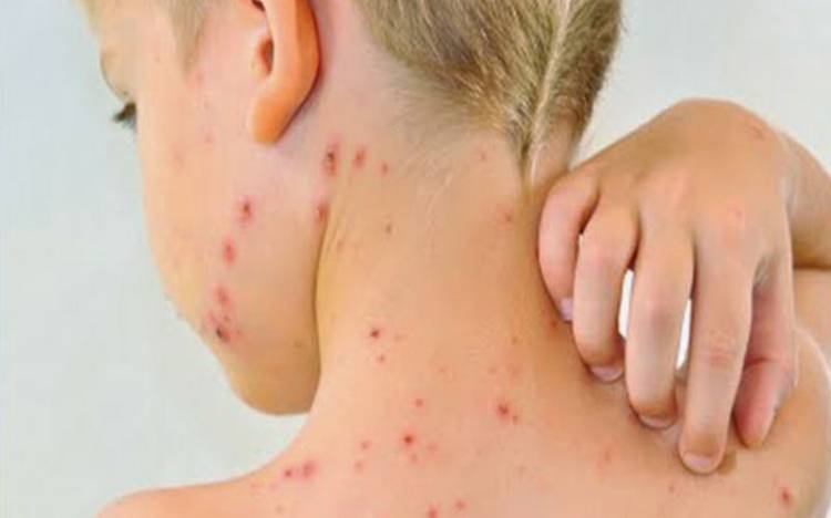 Berasal dari Virus Langka, Yuk Kenali Ciri-Ciri Cacar Monyet, ini Kata WHO!