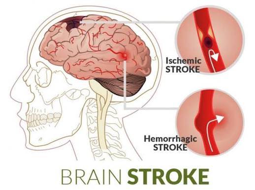 Yastroki Gandeng  PDKI dan KREKI Latih Relawan Penanganan Stroke