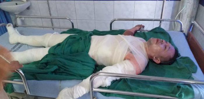 Pekerja Kecebur Dalam Kuali Besar, Badannya Melepuh Seluruhnya