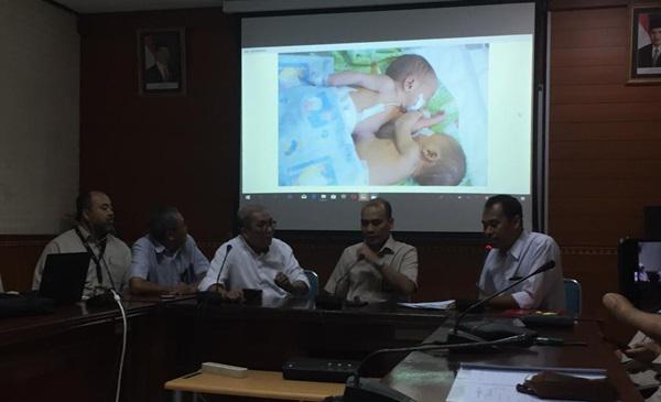 Biaya Pemisahan Bayi Adam-Malik Ditanggung Rumah Sakit