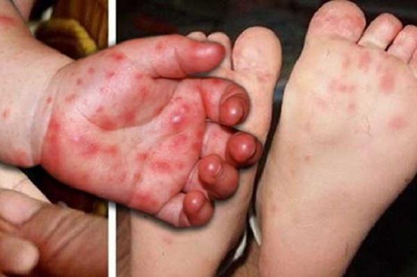 Sejumlah Warga Medan Diduga Terserang Flu Singapura, Eldin Akan Tindaklanjuti