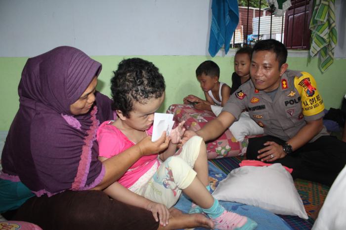 Kapolres Pematangsiantar Bantu Anak Penderita Hidrosefalus dan Korban Kebakaran