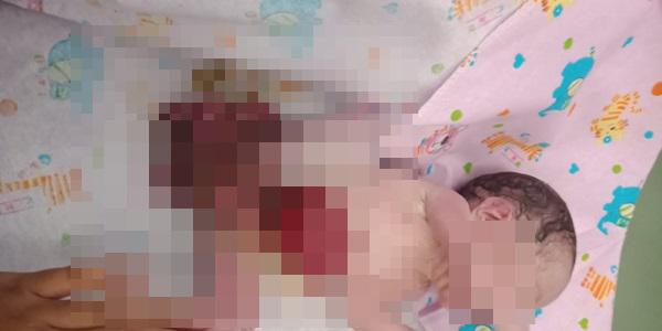 RSUP H Adam Malik Rawat Bayi Dengan Usus Terburai 
