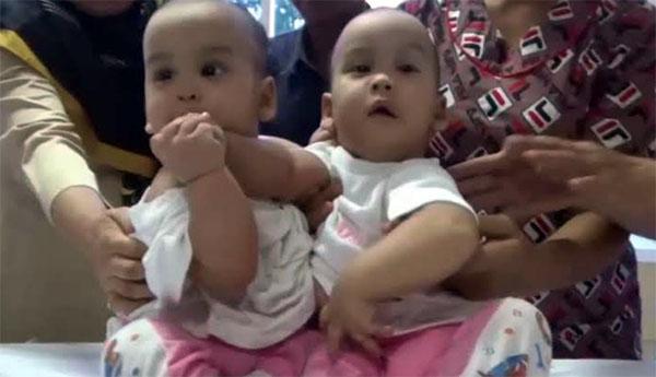 Kembar Siam Adam dan Malik Pulang ke Kampung Halamannya