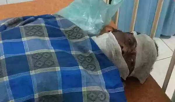 Istri Bakar Suaminya, Gara-gara Tidak Terima Anaknya Dimarahi