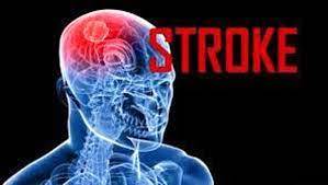 Kenali Gejalanya, ini 3 Awal Stroke yang Paling Umum Terjadi