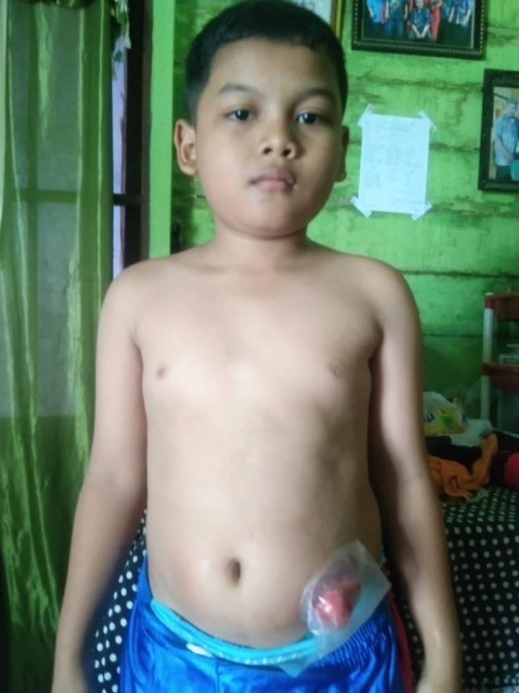 Pasien UHC JKMB Keluhkan Biaya Operasi di RS Haji Medan, Pasien Butuh Biaya Operasi ke 2