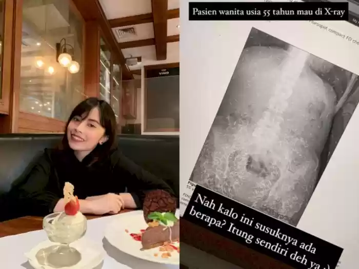 Viral ! Pasien Berusia 55 Tahun Memakai Ratusan Susuk Saat Xray