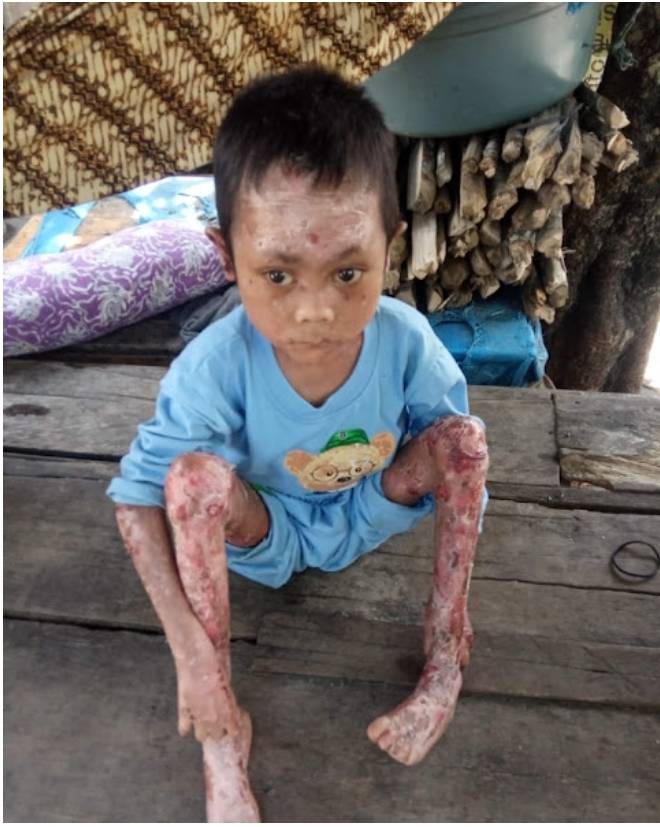 Anak Penderita Penyakit Kulit Ini Butuh Uluran Tangan Dermawan