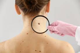 Pengobatan Baru Untuk Kanker Melanoma Oleh Peneliti Eropa