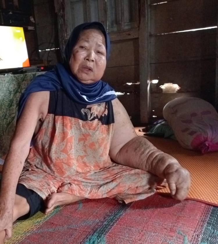 Prihatin, Wanita Paruh Baya Di Sihepeng Tangan Membengkak