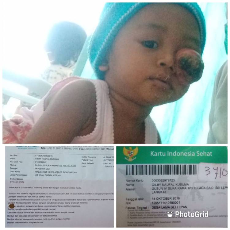 GJS dan Sedulur Selawase Ajak Donasi untuk Penderita Tumor Mata di Langkat
