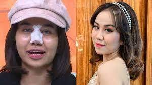 Mayang Lucyana Kembali Jalani Operasi Hidung Supaa Apa...?