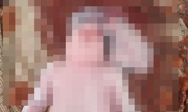 Bayi di Madina Lahir dengan Otak di Luar Tempurung Kepala