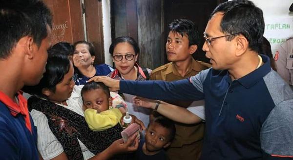JR Saragih Bantu Biaya Perobatan Bocah Penderita Kanker Mata