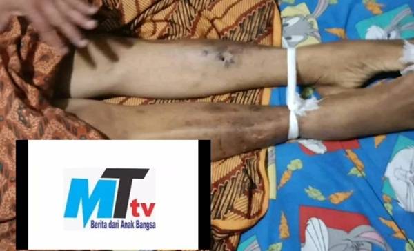 Usai Ditangkap Polsek Medan Kota dan  Ditahan di Polrestabes, Zailani Tewas Lebam-lebam