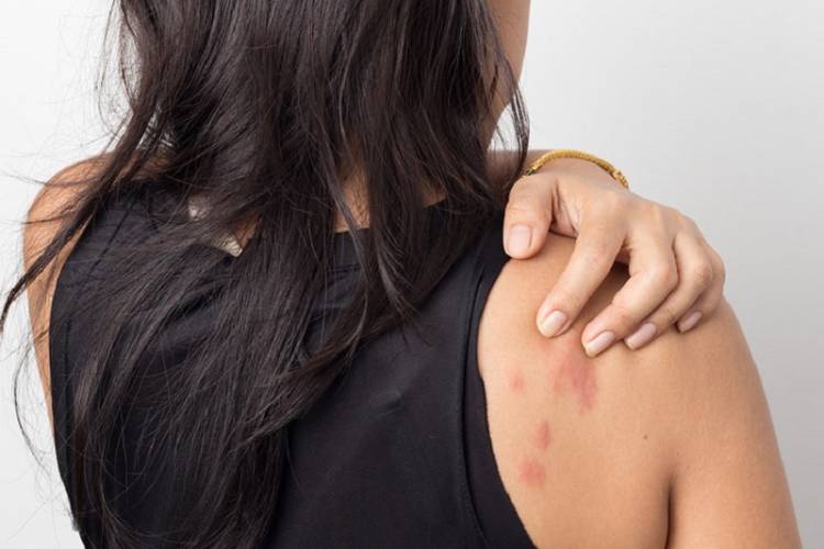 Penyakit Ini Sering Muncul Saat Musim Penghujan, Berikut Tips Mengatasinya