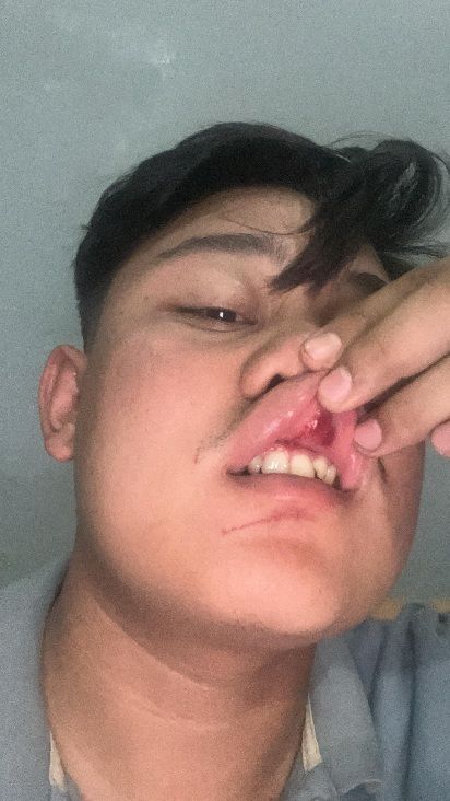 Anak Bilal Mayit Jadi Korban Penganiayaan Ditetapkan Polisi Jadi Tersangka